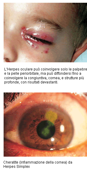 erpes-oculare