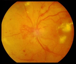 retinopatia diabetica